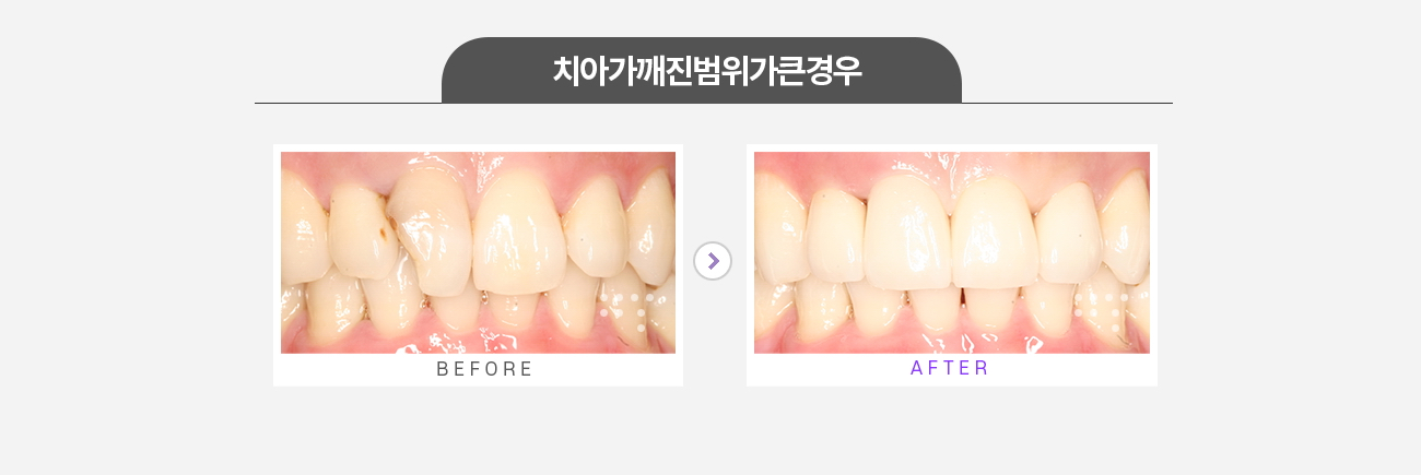 차아가 깨진 범위가 큰 경우 전후 비교 사진