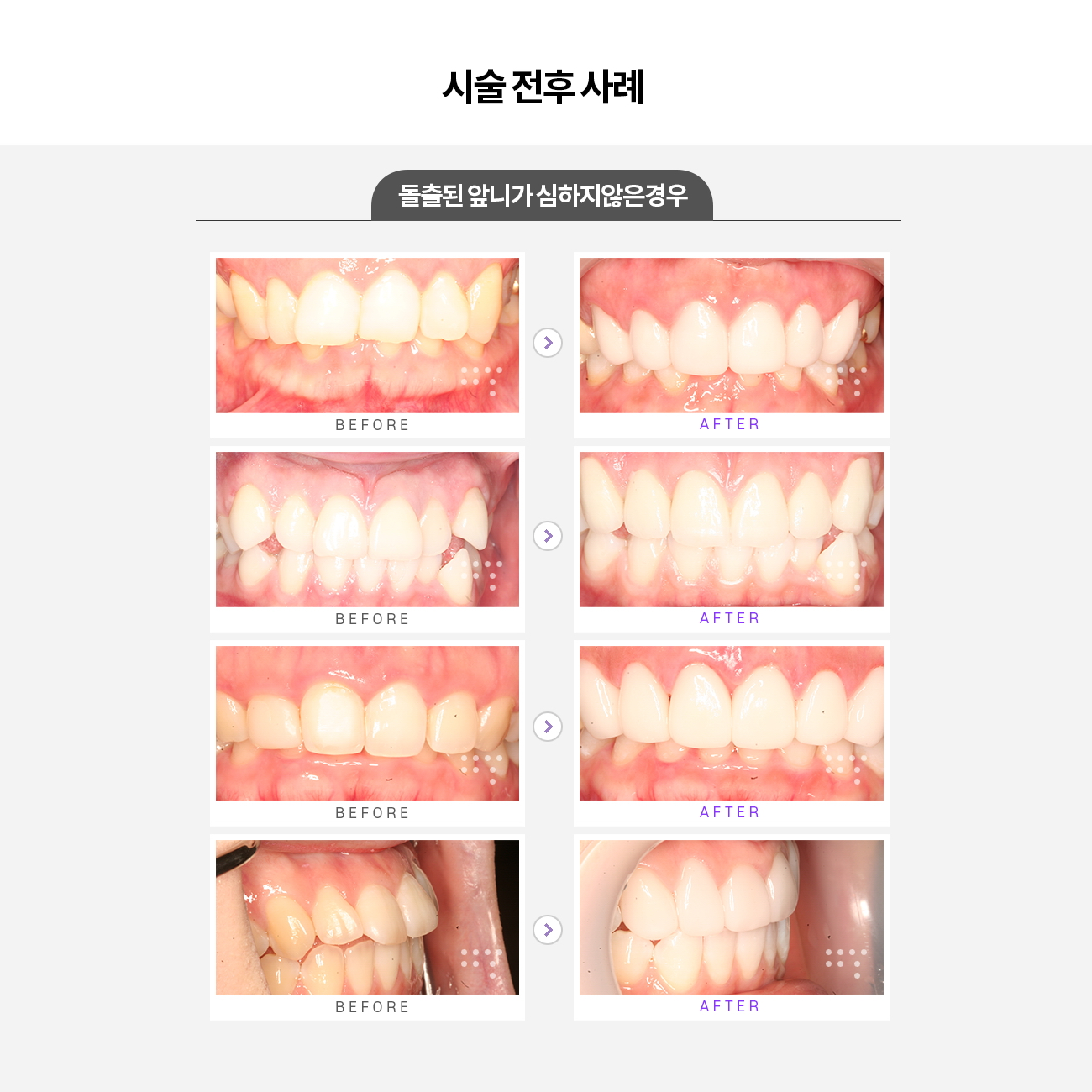 시술 전 앞니
