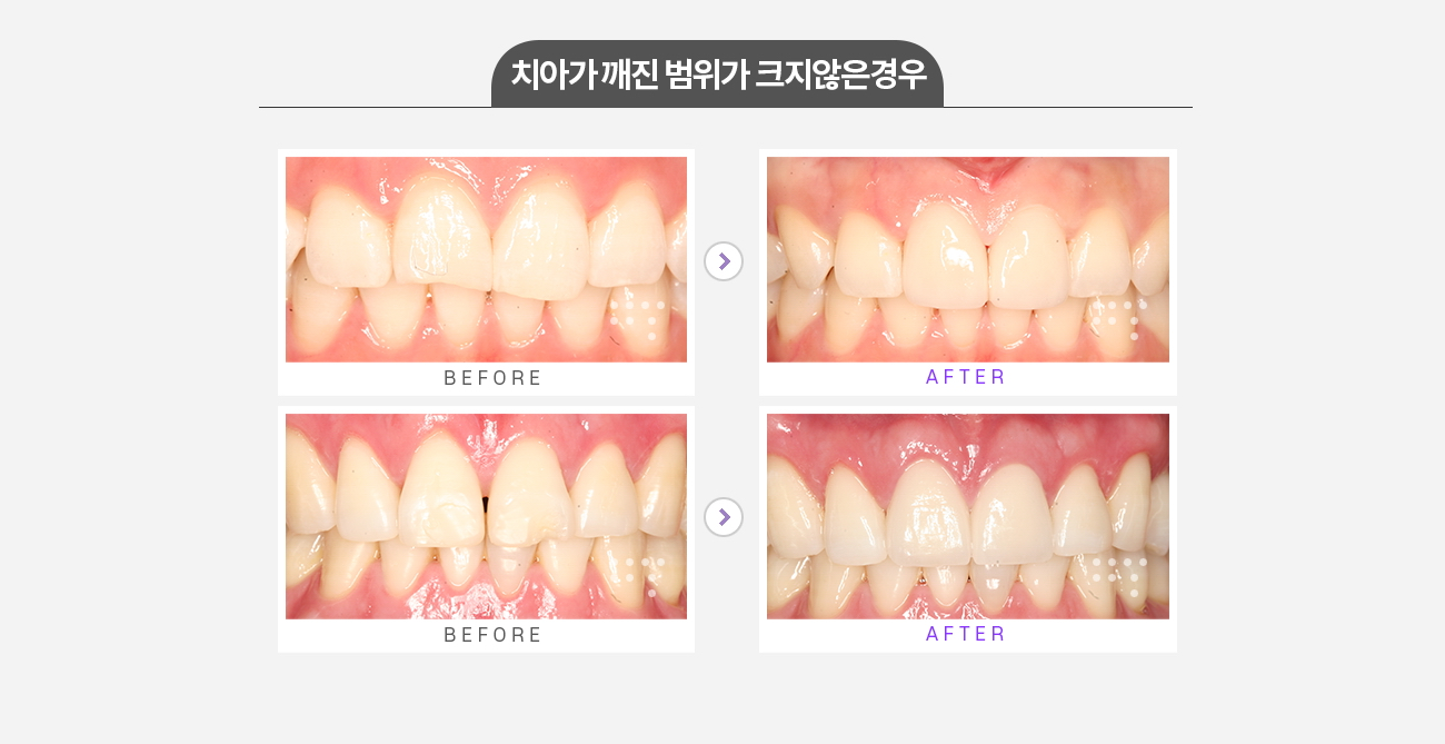 시술 전 앞니
