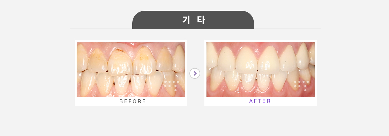 시술 전 앞니
