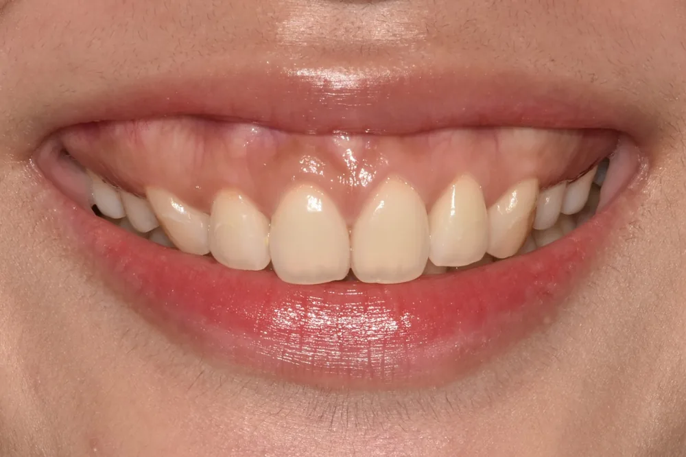 구강전정술 시술 전